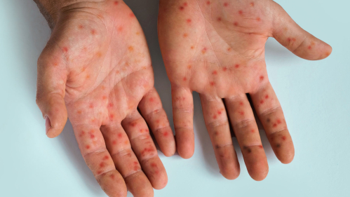 hands with mpox