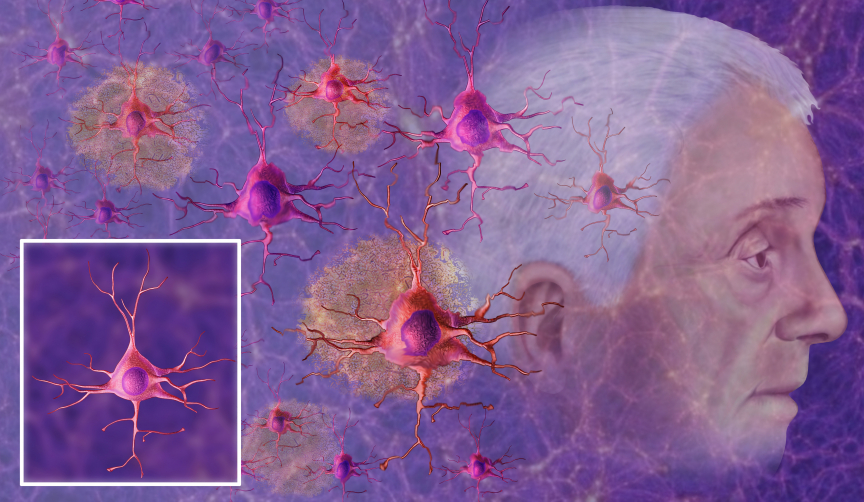 Alzheimer’s May Be Linked To Defective Brain Cells Spreading Disease ...